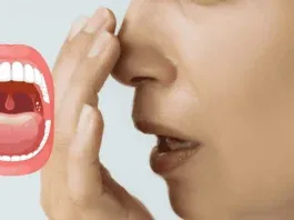 Tonsil Stones Symptoms Bad Breath Prevention Probiotics