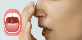 Tonsil Stones Symptoms Bad Breath Prevention Probiotics