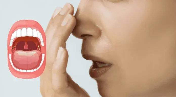 Tonsil Stones Symptoms Bad Breath Prevention Probiotics