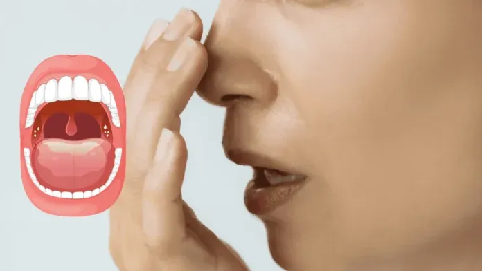 Tonsil Stones Symptoms Bad Breath Prevention Probiotics