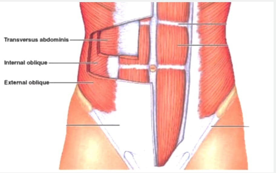 internal oblique(內斜肌)；External oblique(外斜肌)；transverse abdominis muscle(腹橫肌)。資料來源：patienthelp