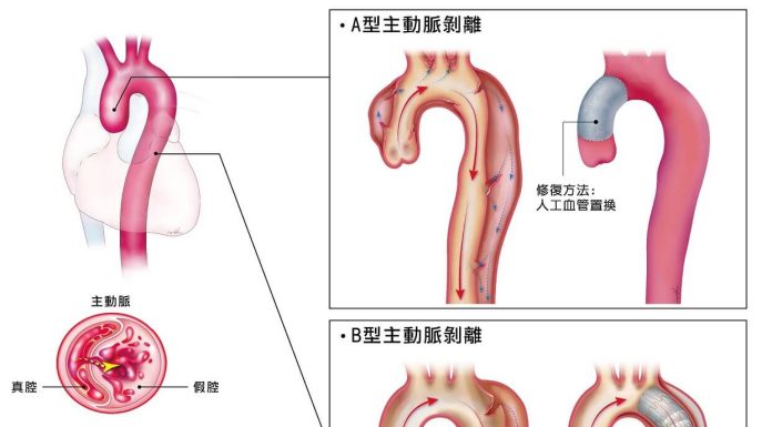 主動脈剝離疾病分為AB兩型。（圖／林口長庚醫院提供）