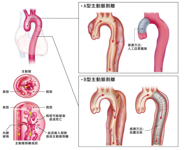 主動脈剝離疾病分為AB兩型。（圖／林口長庚醫院提供）