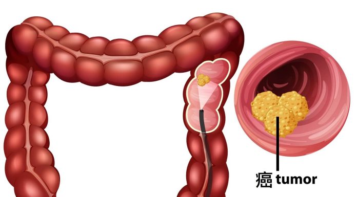 大腸癌