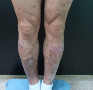 患者盧先生病灶反覆復發嚴重困擾生活 治療前腿部照 
