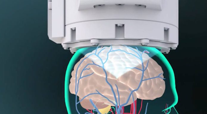 惡性腦瘤臨床試驗成功 手術導航導引聚焦超音波系統!