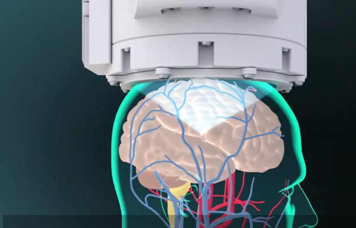惡性腦瘤臨床試驗成功 手術導航導引聚焦超音波系統!