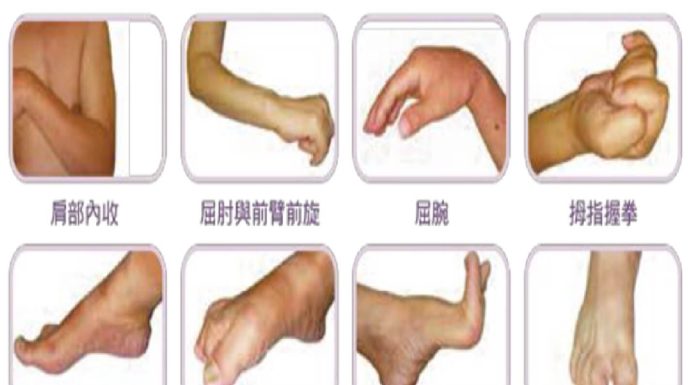 常見的肢體痙攣症狀