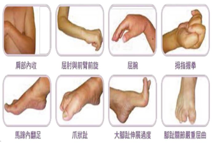 常見的肢體痙攣症狀