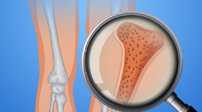 Human Bone With Osteoporosis