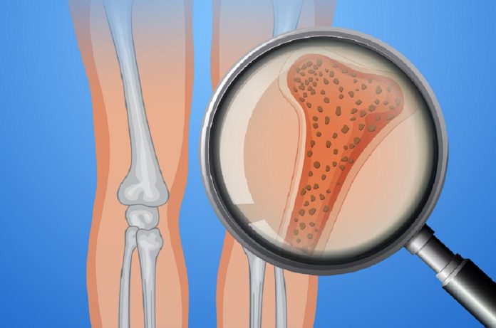 Human Bone With Osteoporosis